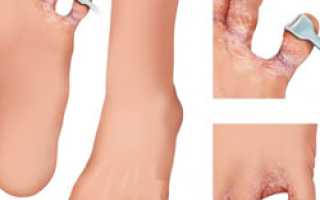 Почему появляются трещины на пальцах ног и как с этим бороться