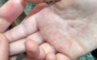 Появилась сыпь на руках и ногах ребенка — что это может быть и как помочь