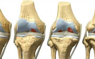 Лечение гонартроза коленного сустава 1 степени