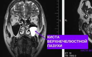 МРТ пазух носа