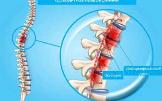 Остеоартроз позвоночника