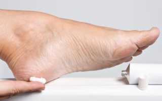 Трещины на пятках — все про них и их лечение