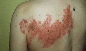Пятна на коже, похожие на лишай — что это и как с этим бороться?