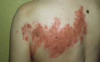 Пятна на коже, похожие на лишай — что это и как с этим бороться?