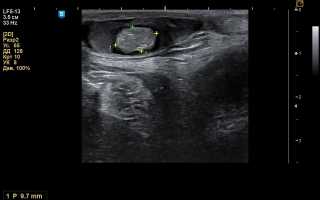 Дермоидная киста на узи