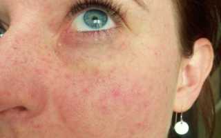 На лице появились красные точки — что делать в такой ситуации
