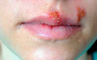 Герпес на губах при беременности в первом