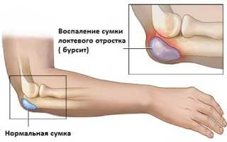 Локтевой бурсит