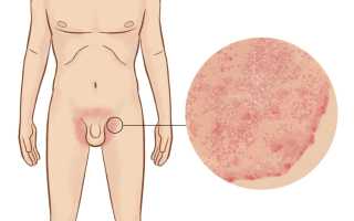 Покраснения в паху у мужчин: причины и лечение