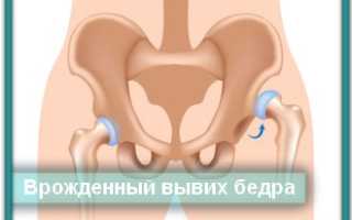 Врождённый вывих бедра
