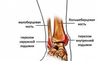 Перелом лодыжки