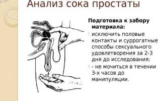 Мазок секрета простаты