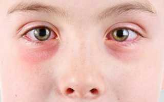 Почему появляется покраснение вокруг глаз и как с этим справиться?