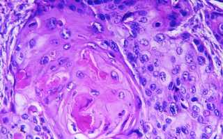 Виды плоскоклеточного рака