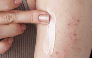 Мазь от чесотки — какие самые эффективные средства для лечения