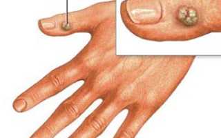 Бородавка на пальце руки — что с ней делать и как избежать?