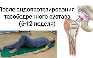 Упражнения после эндопротезирования тазобедренного сустава