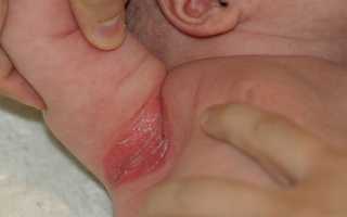 Красные пятна под мышками: причины и лечение