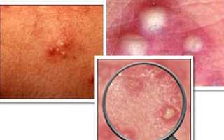 Почему появляются прыщи на яйцах у мужчин: причины и советы