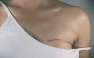 Гормонозависимый рак молочной железы прогноз