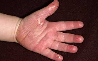 Почему шелушится кожа на ладонях и пальцах рук? Узнайте причины и решения