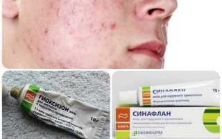 Для чего нужна мазь Синафлан? Узнайте все детали