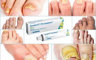 Мази от грибка стопы – какую выбрать для эффективного лечения