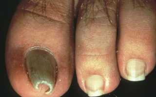 Почему потемнели ногти на больших пальцах ног? Узнайте причины и решения