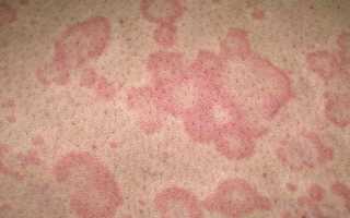 Красные шелушащиеся пятна на теле: причины и лечение