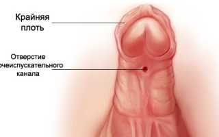 Гипоспадия у мальчиков: причины и лечение