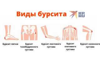 Несколько слов о бурсите тазобедренного сустава