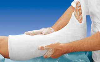 Лонгетная повязка на стопу