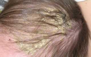 Почему у ребенка на голове появляются желтые корочки? Узнайте причины и советы