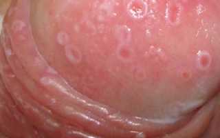 Бывает ли у мужчин молочница? Важные аспекты здоровья