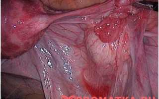 Лечение хронического воспаления яичников