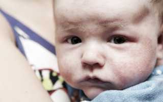 Диатез у ребенка — генетическая предрасположенность к аллергии и ее последствия