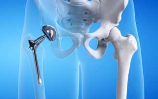 Эндопротезирование суставов