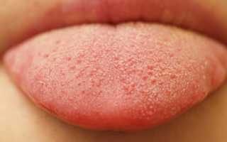 Почему на языке появляется белый налет? Узнайте причины и последствия.