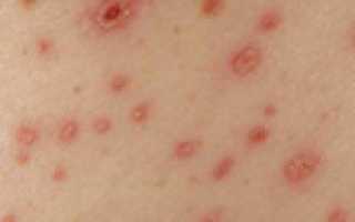 Инфекционное заболевание глпс