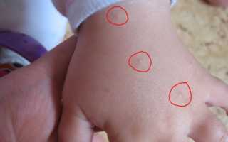 Как выглядит чесотка и её симптомы