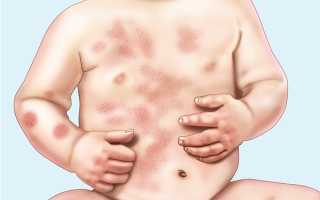 Как проявляется аллергический дерматит у детей: симптомы и лечение