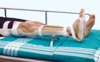 Как наложить шину при переломе голени