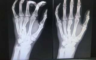 Перелом кисти руки
