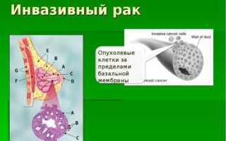 Инвазивный неспецифицированный рак молочной железы 2 степени