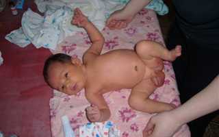 Водянка у малышей