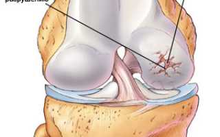 Лечение артрита