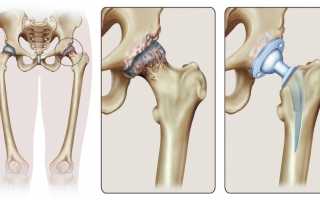 Лечение коксартроза тазобедренного сустава 4 степени