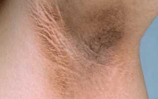 Появляются темные пятна под мышками, что делать? Полезные советы и рекомендации