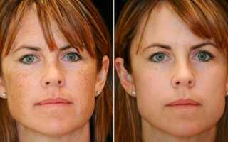 Как быстро убрать пигментные пятна на лице? Полезные советы и рекомендации