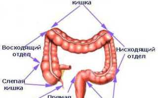 Дивертикул сигмовидной кишки